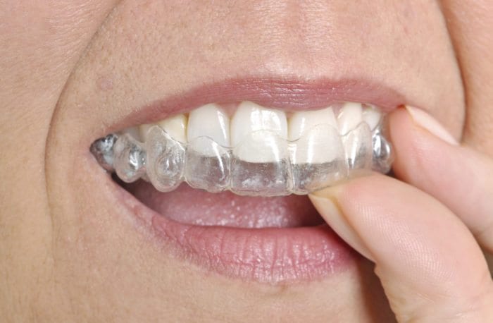 Straighten teeth with Invisalign in Bel Air MD