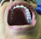 tooth crown replacement in Fallston, MD
