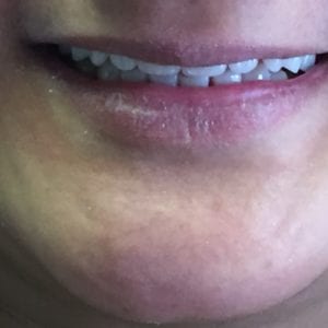After denture partial in Fallston MD