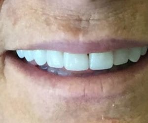 After smile makeover in Fallston, MD