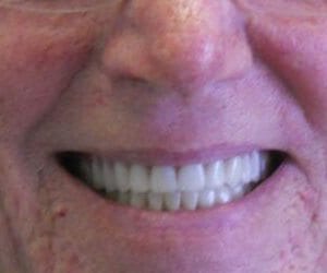 after dentures and crowns procedure