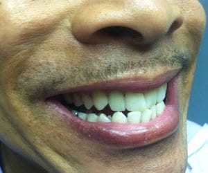 After professional teeth whitening in Fallston, MD