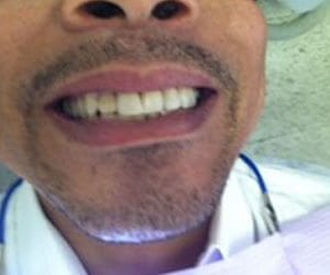 Before professional teeth whitening in Fallston, MD
