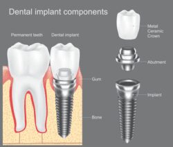 affordable dental implants in Fallston Maryland