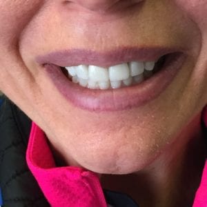 After dental crowns treatment in Harford County, MD