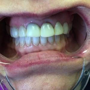 Before dental crowns treatment in Harford County, MD