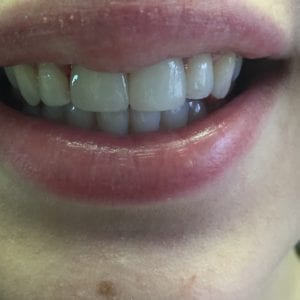 After dental crowns procedure in Fallston, MD