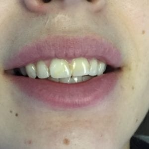 Before dental crowns procedure in Fallston, MD