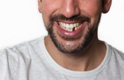 Replacement Options for Missing Teeth