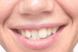 Have You Considered Invisalign in Fallston, Maryland?