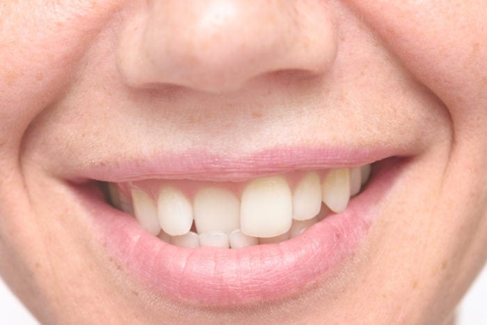 Straighten teeth with affordable cosmetic dentistry in Bel Air MD