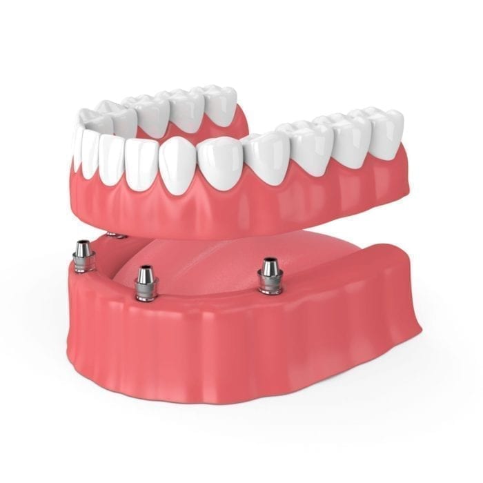 dental implants vs dentures in Fallston MD