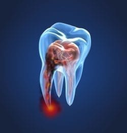 painless root canals with dentist in Bel Air, Maryland