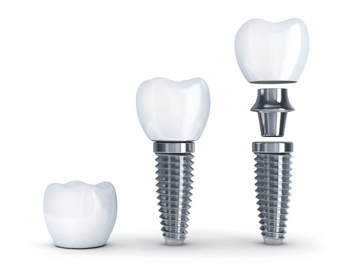 Dental Implant procedure in Fallston MD