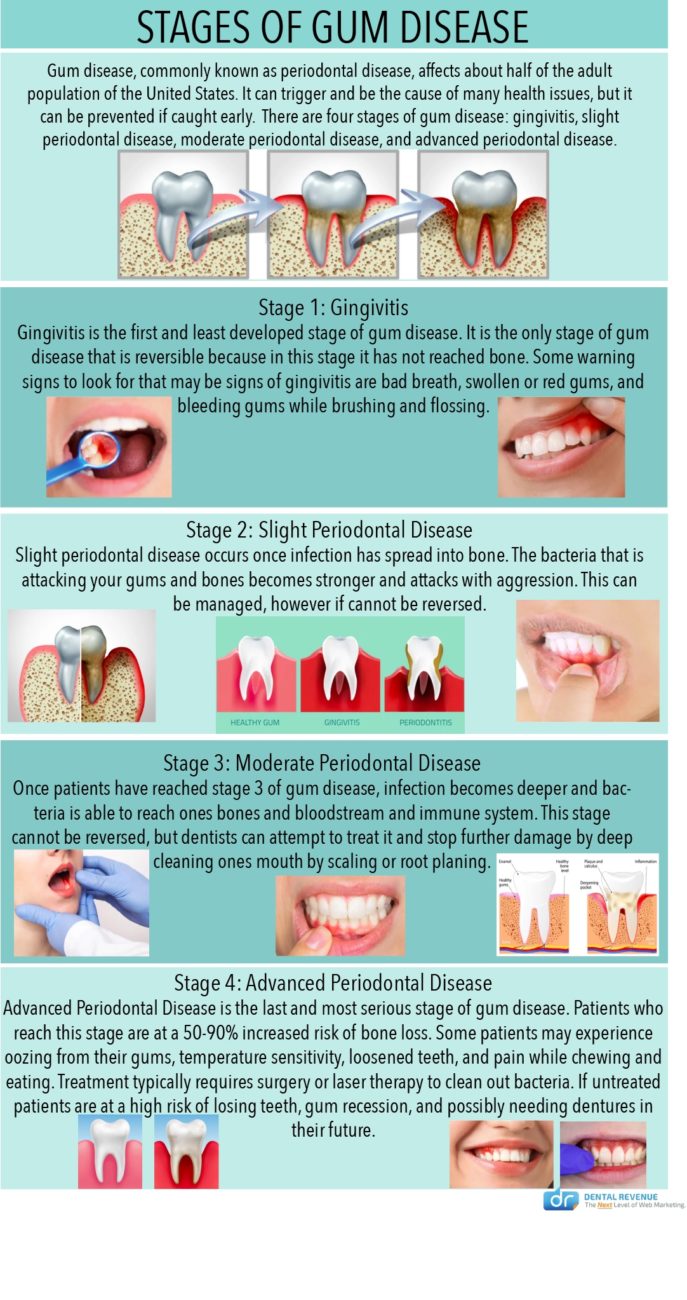 stages of gum disease infographic
