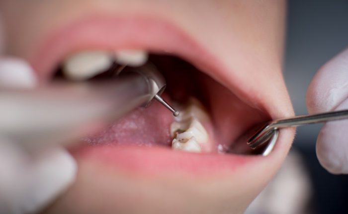 closeup of dental filling procedure cavities dentists in Fallston Maryland