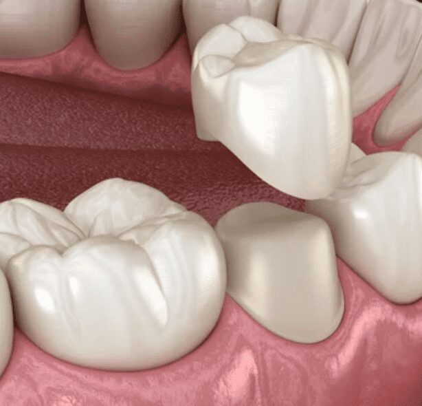 3D render of a dental crown being placed on a reshaped tooth restorative dentistry dentist in Bel Air Maryland
