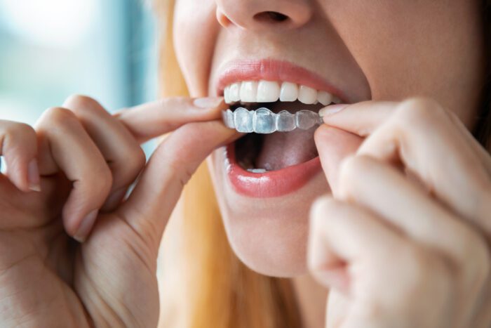 Improve Your Oral Health with Invisalign