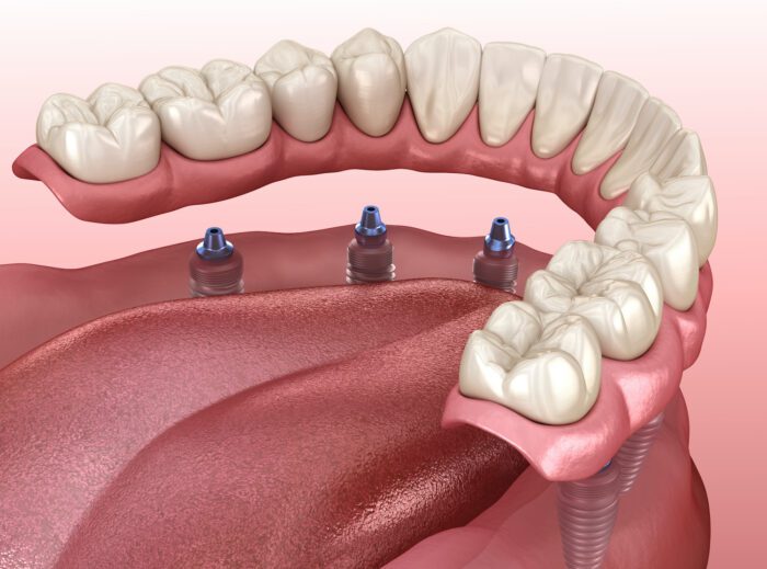 MULTIPLE DENTAL IMPLANTS in Fallston MD can help with a variety of dental issues